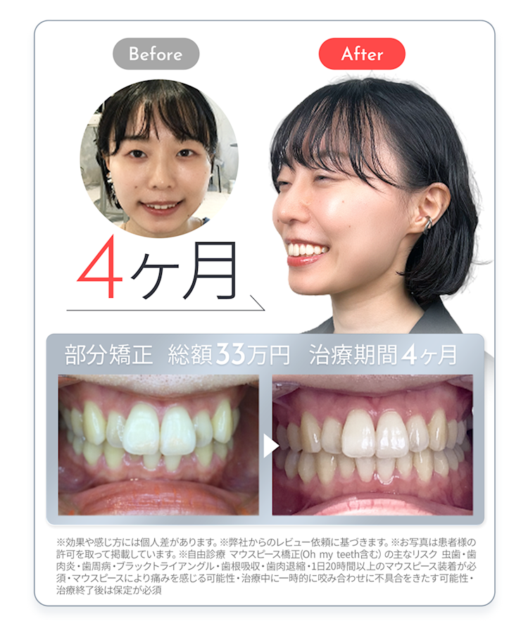 出っ歯cases-1 
